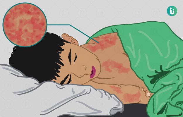 গত ২৪ ঘণ্টায় হামের উপসর্গে ১০ শিশুর মৃত্যু, আক্রান্ত বেড়ে উদ্বেগজনক পরিস্থিতি