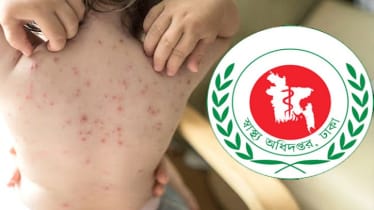 দেশে হাম ও হামের উপসর্গে পাঁচজনের মৃত্যু, আক্রান্ত আরও ১,০৩১